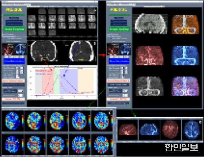 혈관재개통 환자 선별 S/W